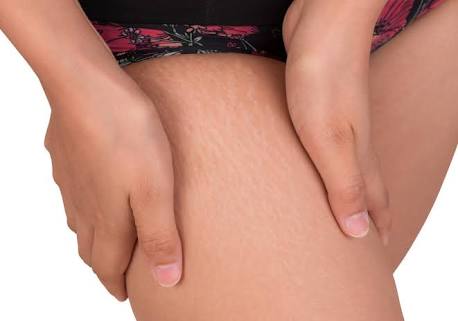 DIY Wednesday: Learn How To Get Rid Of Unsightly Stretch Marks Permanently From The Body