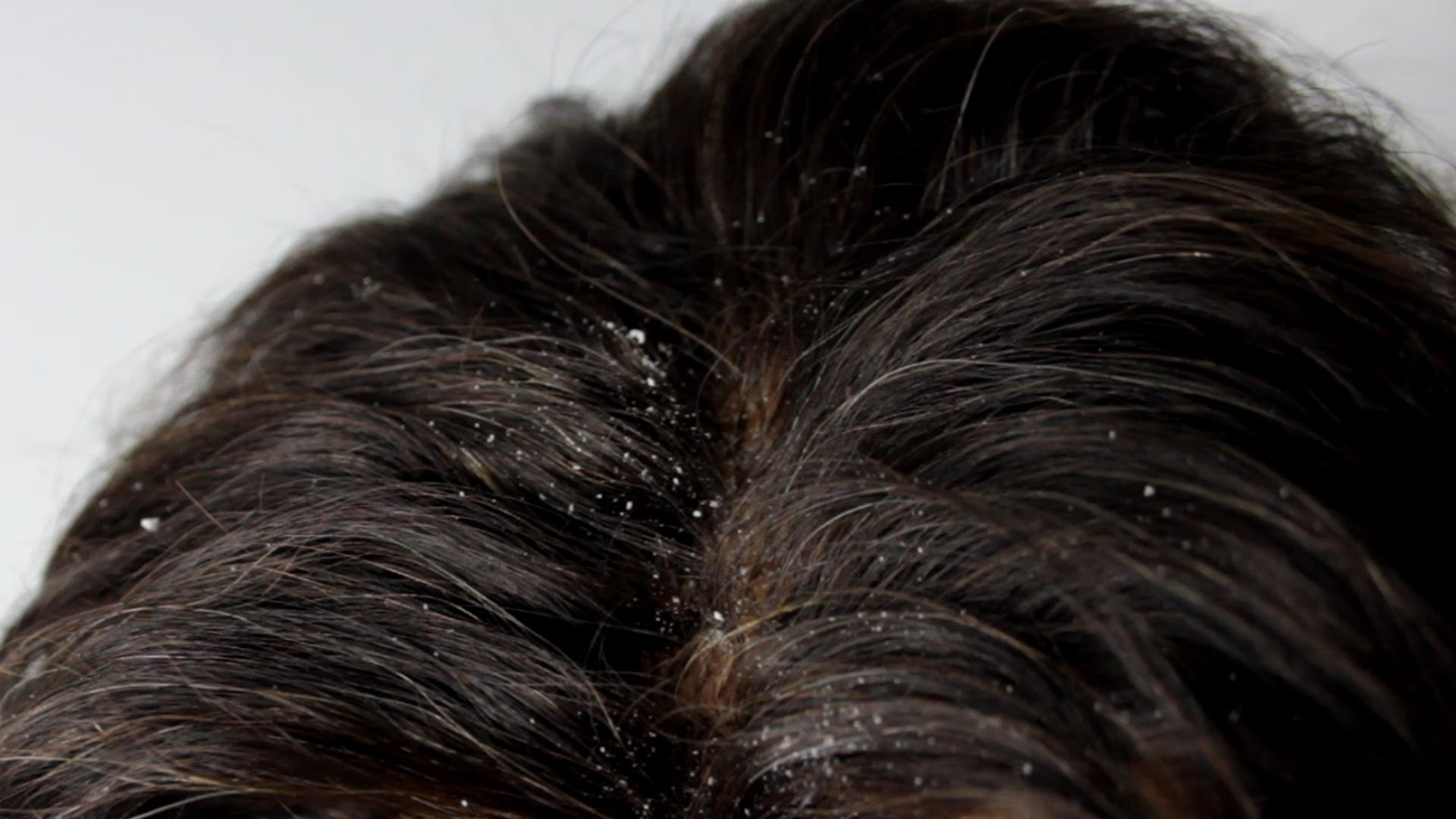 Maddening Itchy Scalp? Try These!