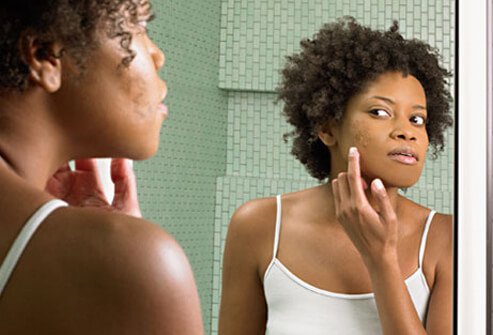 Get Rid of Those Stubborn Pimples With These Remedies