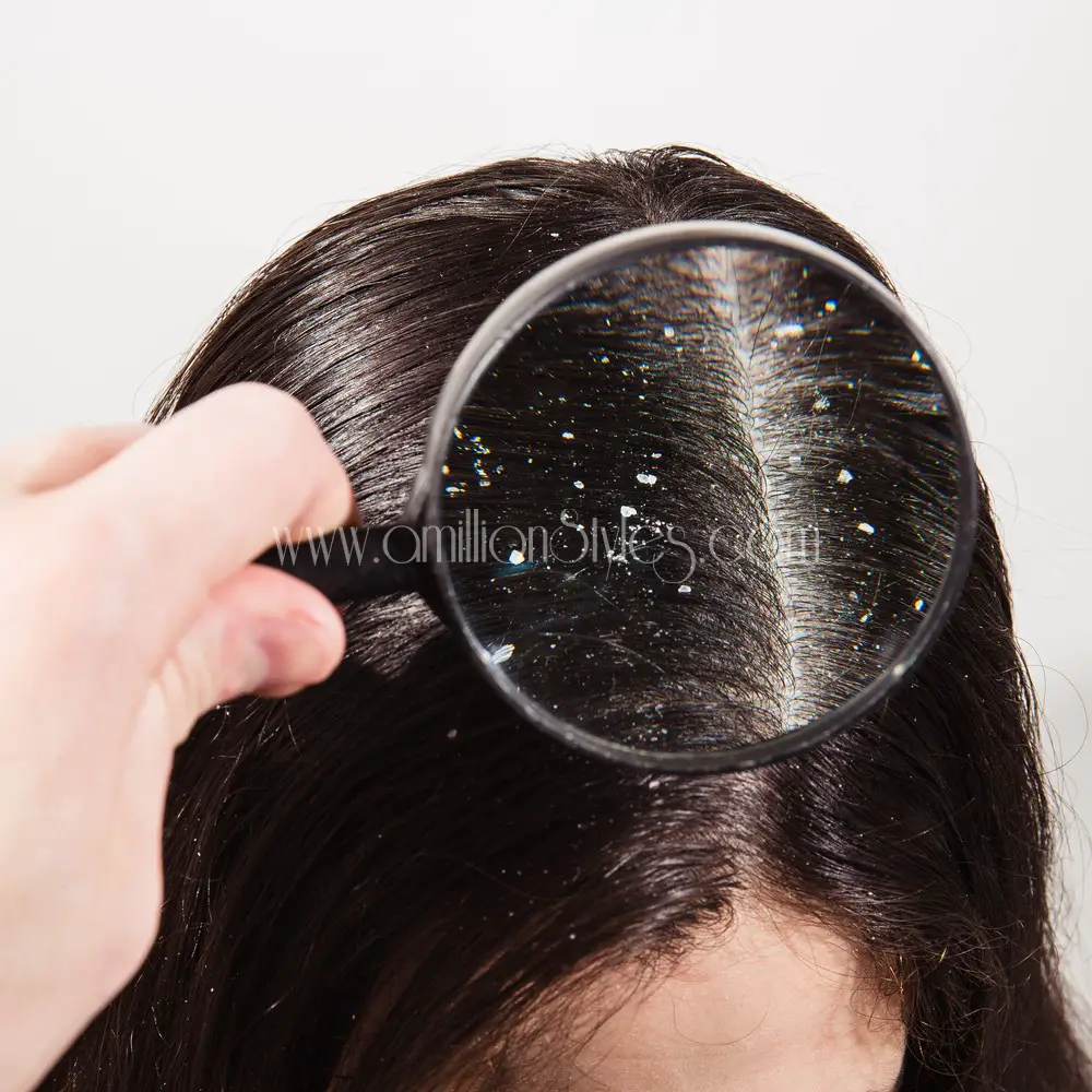 Check Out Ways To Treat Hair Dandruff