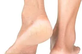 How To Prevent Cracked Heels This Harmattan